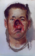 Henry Tonks With Severe Nose Injury 1918 Fine Art Print