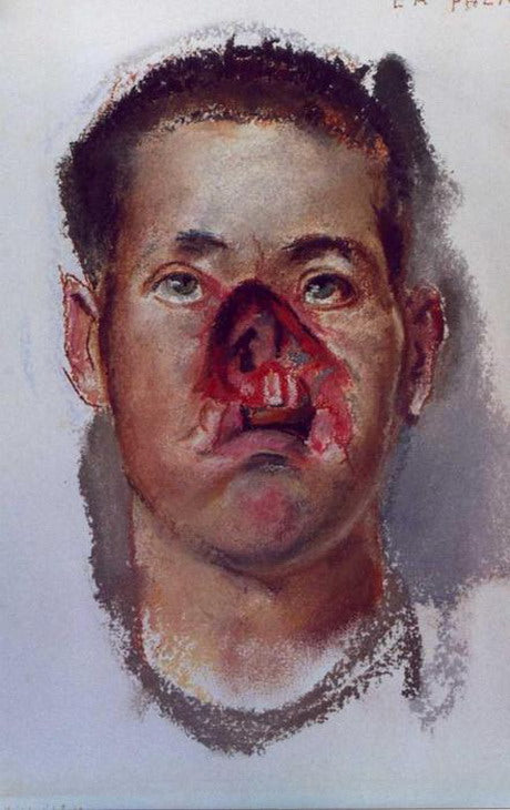 Henry Tonks With Severe Nose Injury 1918 Fine Art Print